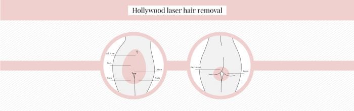 What Is Hollywood Laser Hair Removal Urbana