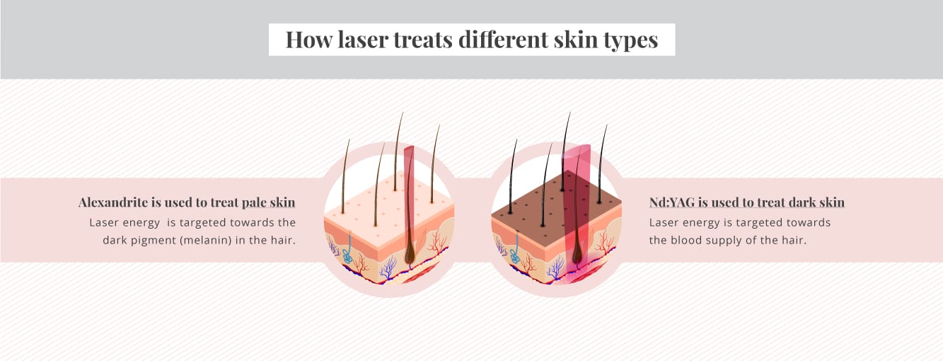 Side Effects Of Laser Hair Removal You Should Know About