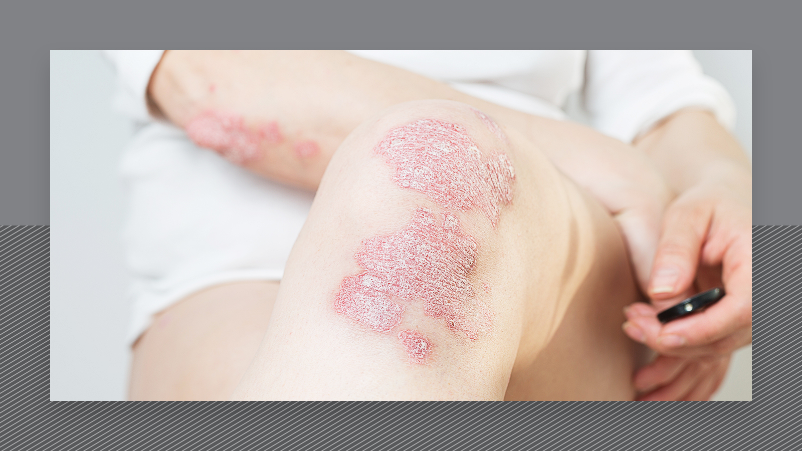 hair removal with psoriasis)