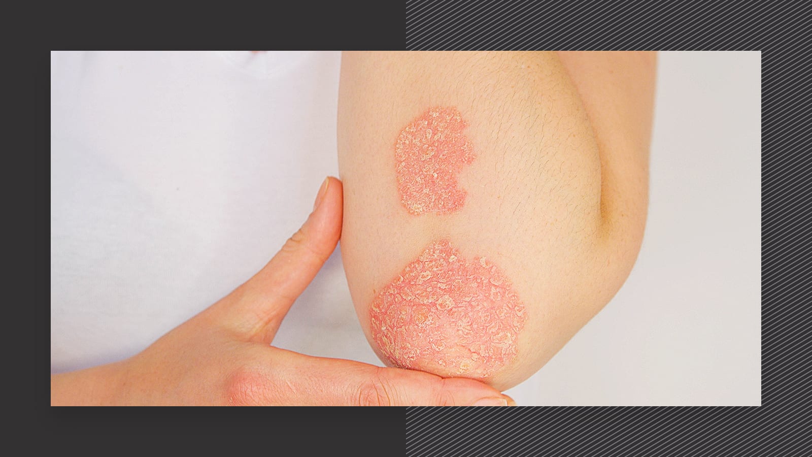 before and after laser treatment for psoriasis